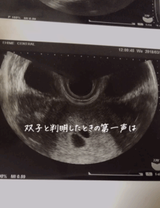 「ふたごだと思っていた」双子妊娠が判明、5年後の姿に→「不思議です」「私も」