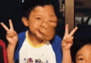 生まれてきたわが子の顔に違和感。「生まれつき顔に腫瘍がある」→救急搬送され、判明した難病。その16年後の現在に迫る