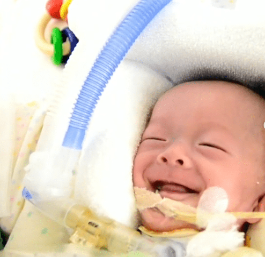 気管切開の手術を頑張ったつむちゃん（＠futag0papaさんより提供）