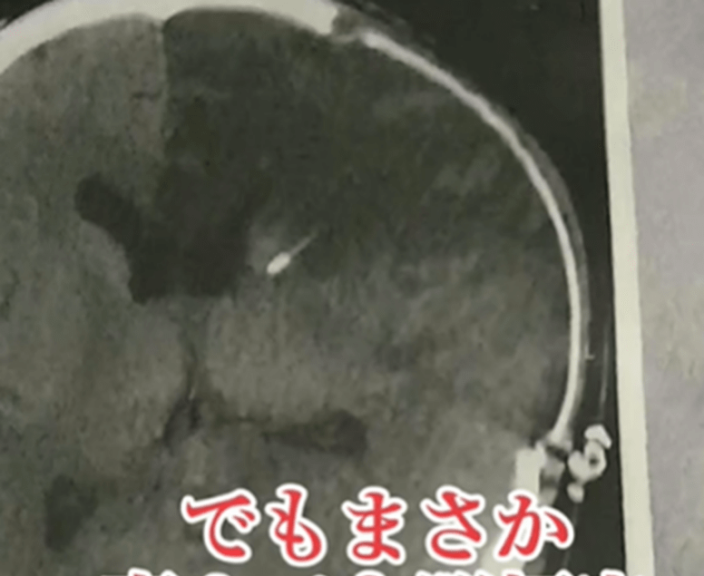 「ふくらはぎが痛い」足に違和感。その後…医師「命に関わります」判明した病とは　妻を支える夫に迫る