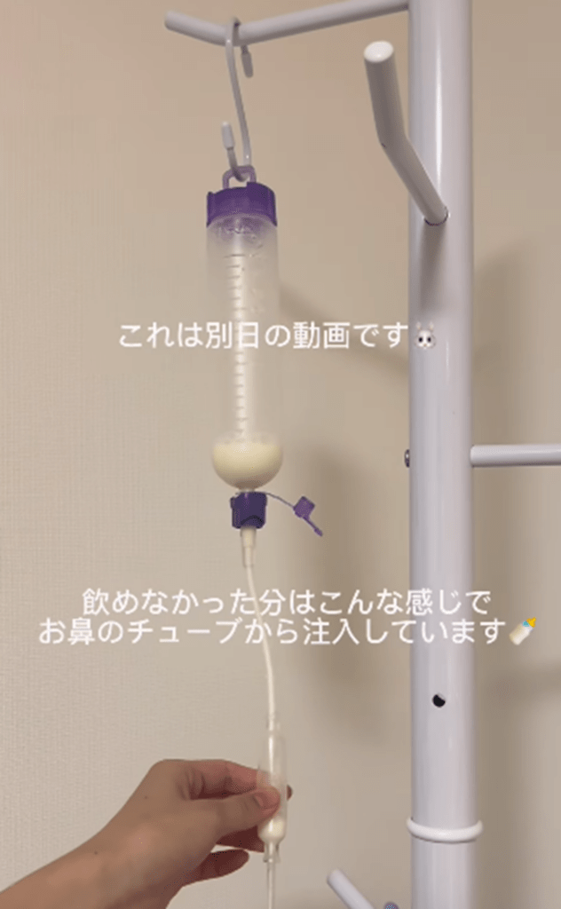 飲めなかったミルクは鼻のチューブから（＠haya.meiさんより提供）