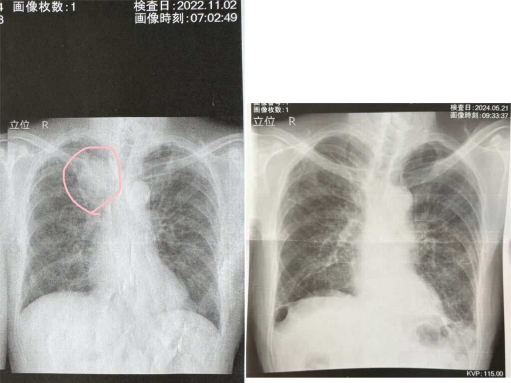 おじいちゃんの肺の様子（@asobiworldさんより提供）