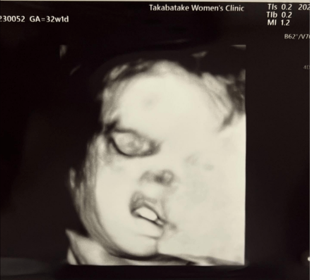 妊娠30週のエコー写真①（@ki_to1018さんより提供）
