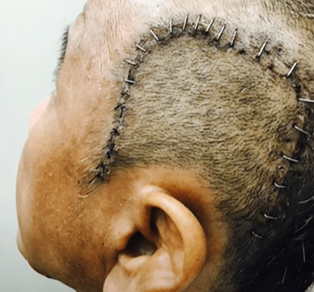 脳出血で手術を…（@sosovlog0406さんより提供）