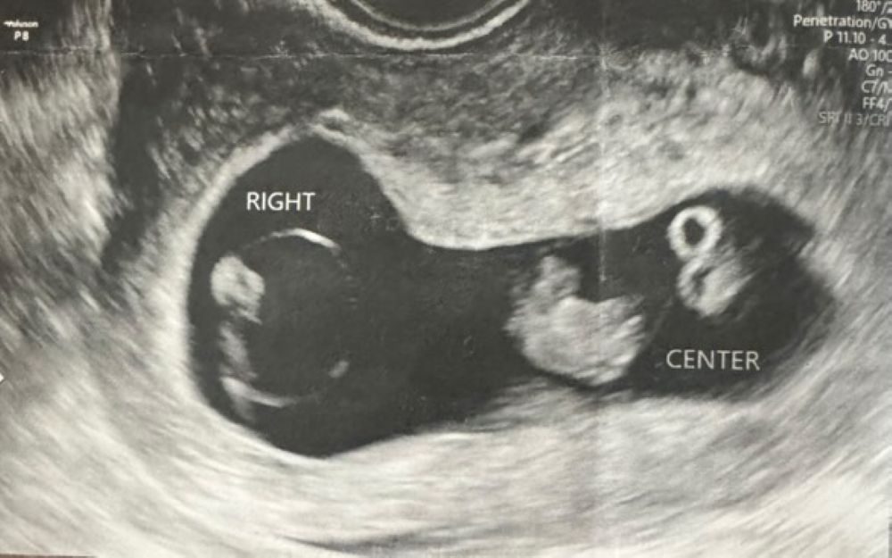 エコー写真②（＠mitsugoma0123さんより提供）