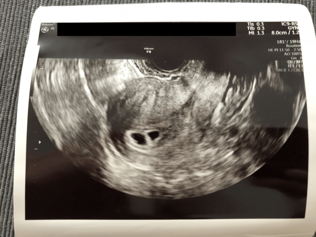 【実際の写真】　エコー写真の様子