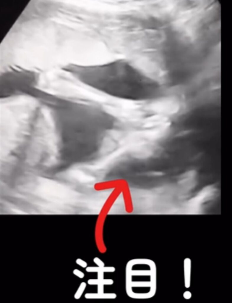妊娠5ヶ月の頃のエコー写真（＠ohana_yuru.ikujiさんより提供）