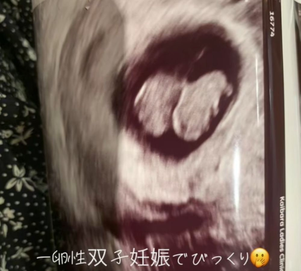 【実際の写真5枚】　エコーに写ったもの