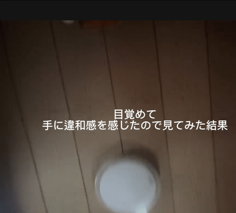 目覚めると手に違和感が…（@n895359さんより提供）