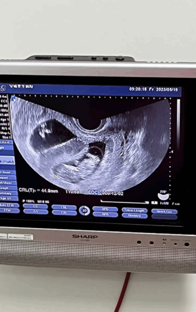 そしてついに妊娠（@ftl.twinsさんより提供）