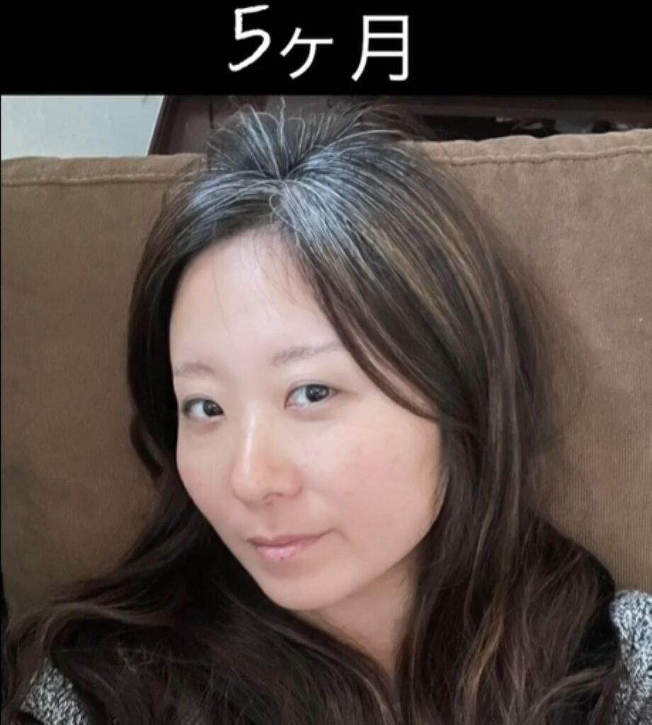 白髪染めをやめて5ヶ月（＠grayhairvlogsさんより提供）