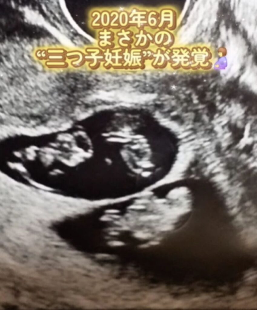 三つ子を妊娠（＠asuka_4kids__さんより提供）