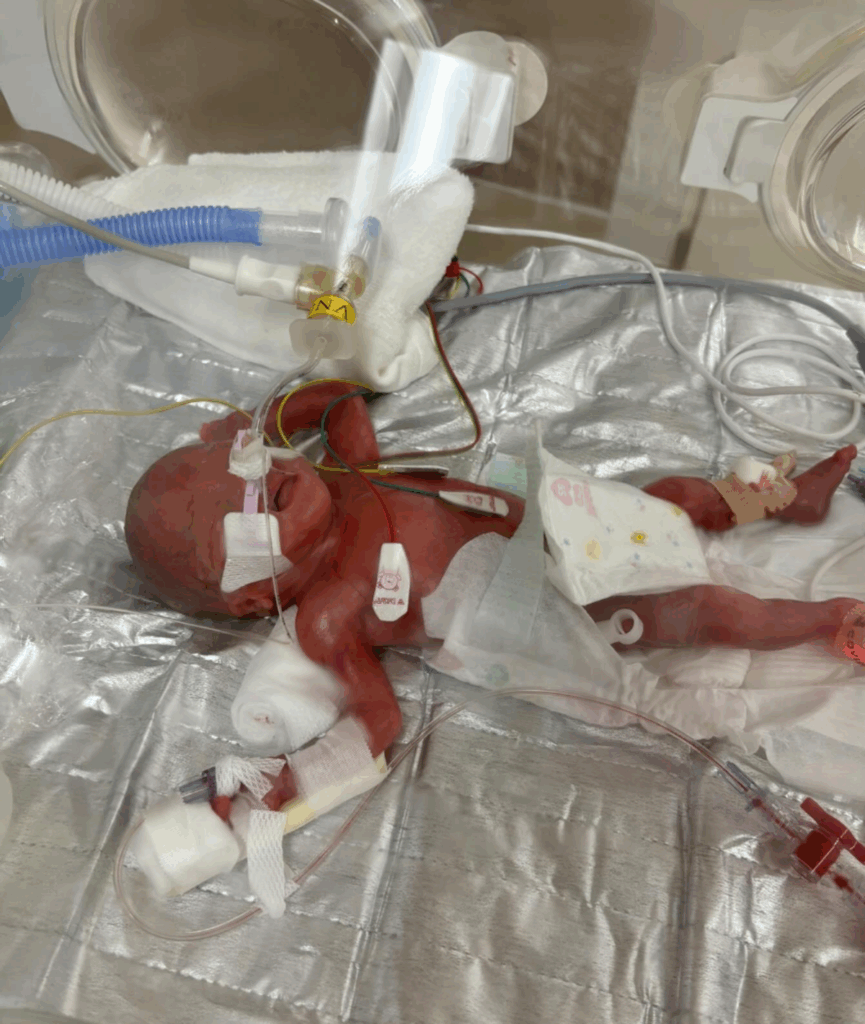 小さな体で産まれた妹さん（@syk.71さんより提供）