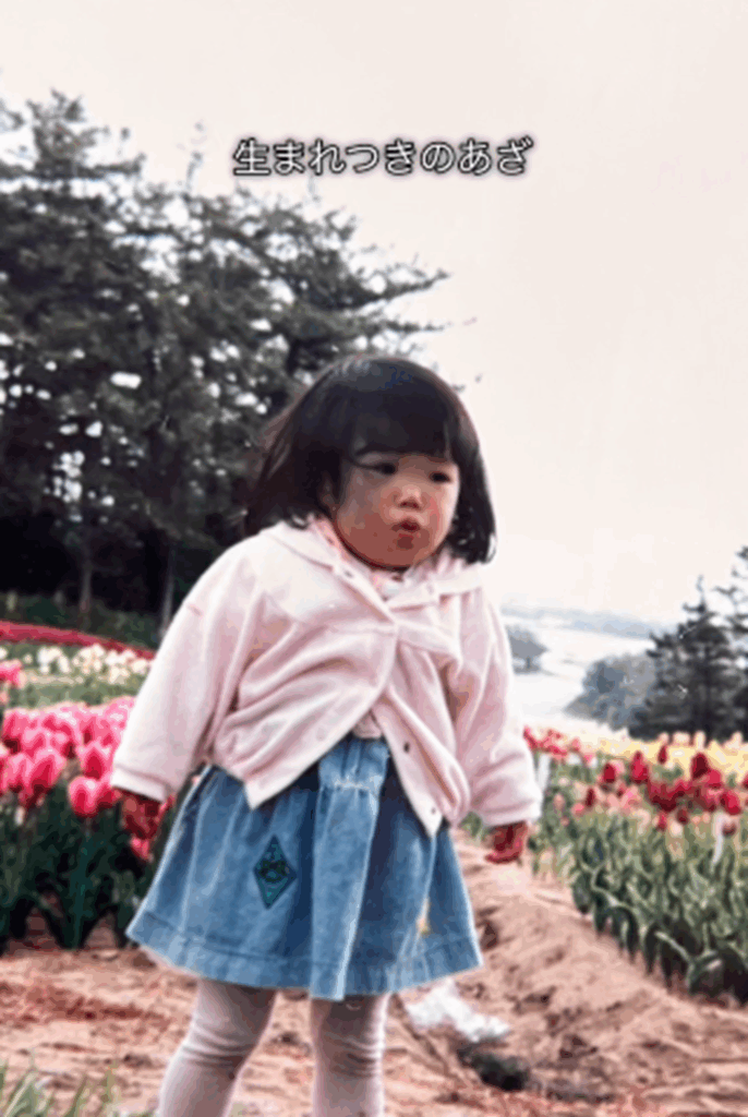 生まれつきあざがあった（＠azami.skin.makeさんより提供）