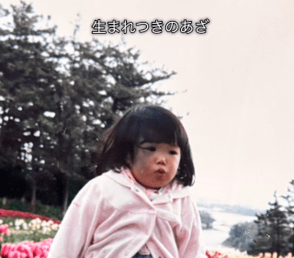 顔の右半分にアザがある女の子「隠しながら生きてきた」　→しかし、大人になった現在の姿に「素敵です」「励まされます！」　　SNSでの発信をする理由に迫る