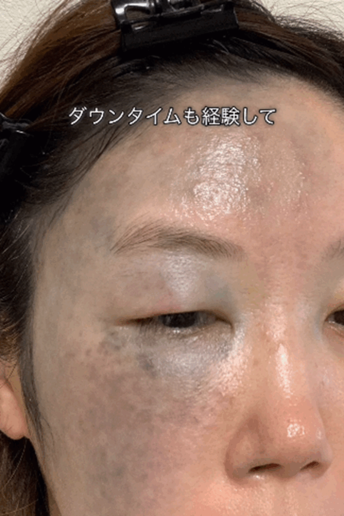 ダウンタイムも経験（＠azami.skin.makeさんより提供）