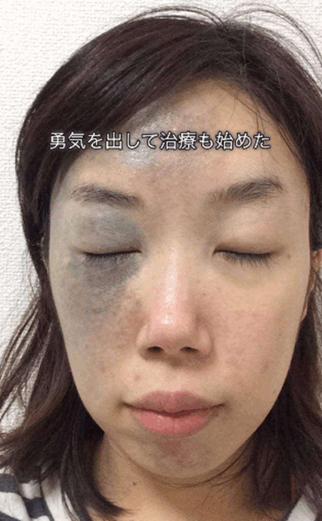 勇気を出して治療を開始（＠azami.skin.makeさんより提供）