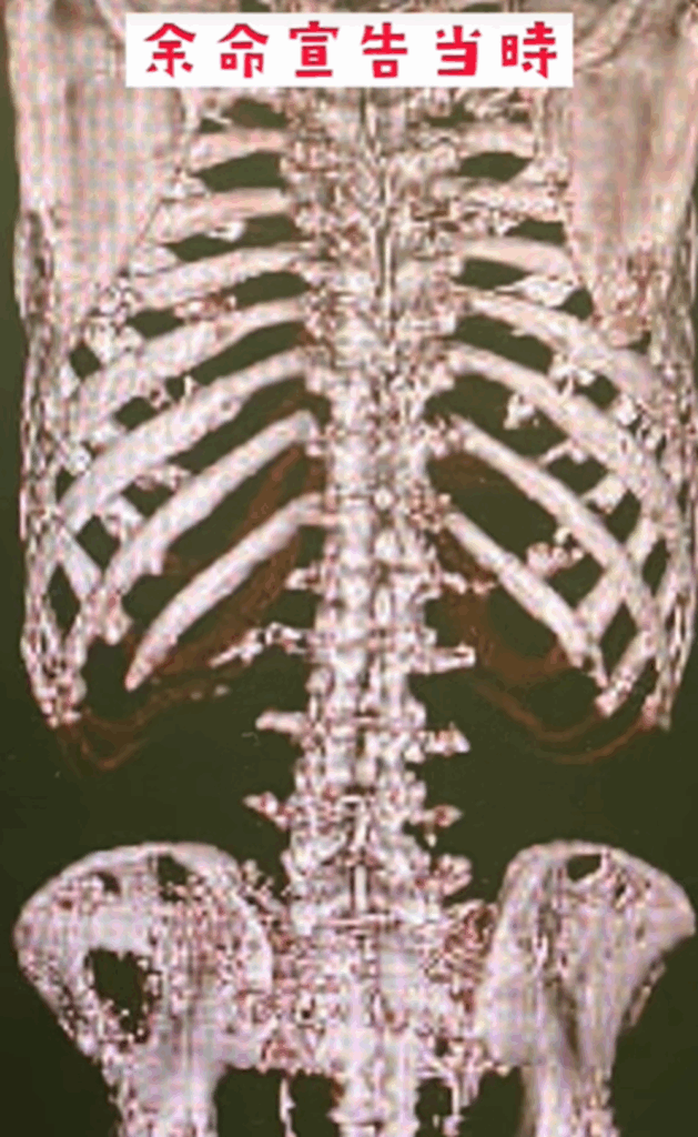 【実際の写真】乳がんと戦う姿