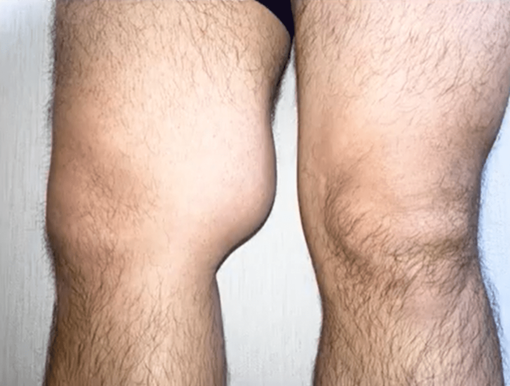 ひざ裏の腫瘍（ノビ山本さんより提供）