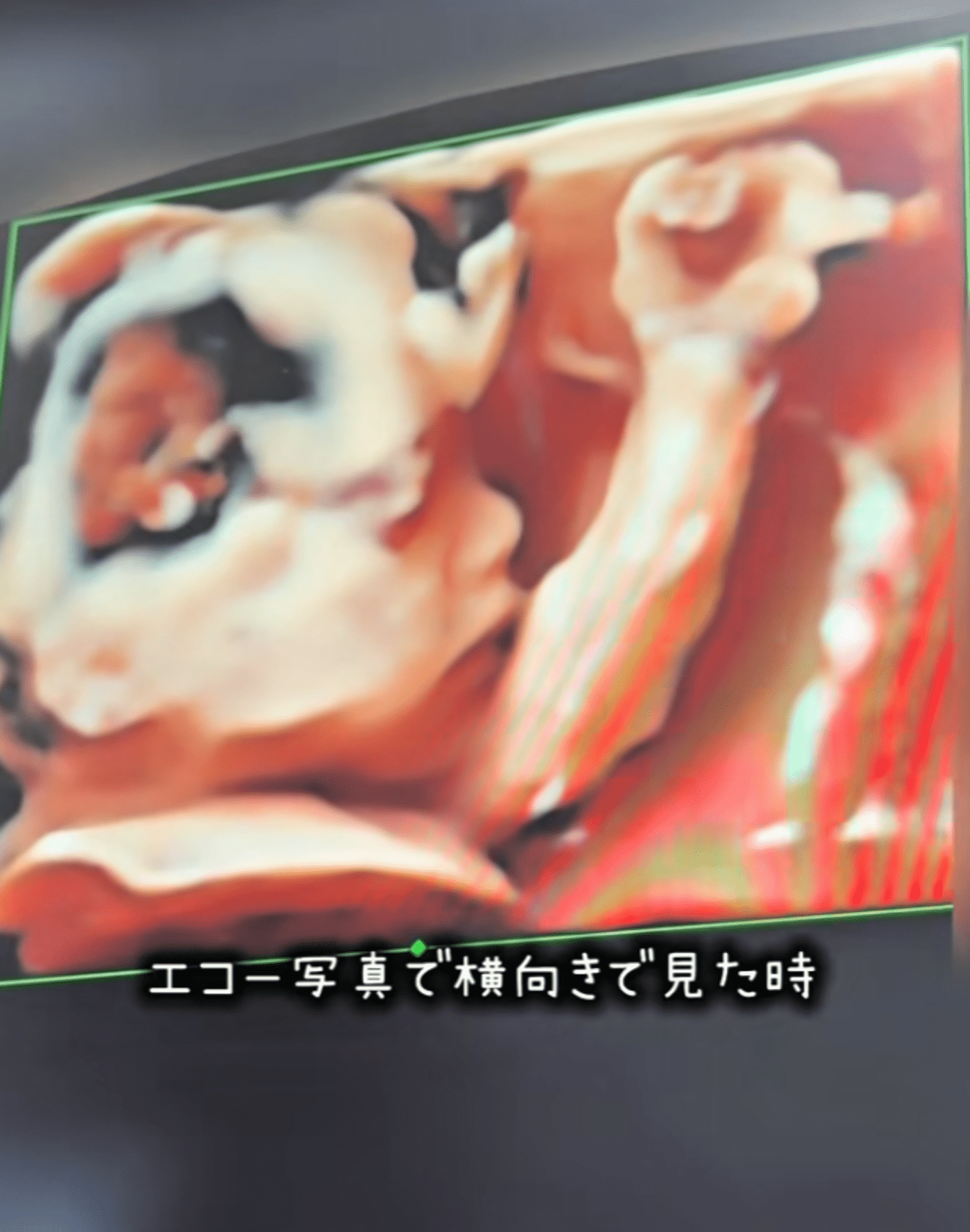 エコー写真で「鼻が高い」と言われた赤ちゃん　→現在の様子に「可愛すぎる！」「癒しをありがとうございます」