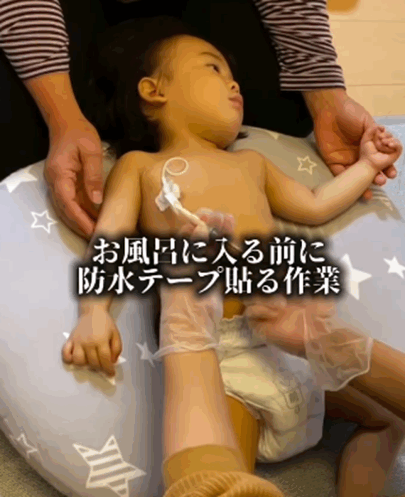 お風呂に入るときには防水テープを貼る作業を（＠soragram410さんより提供）