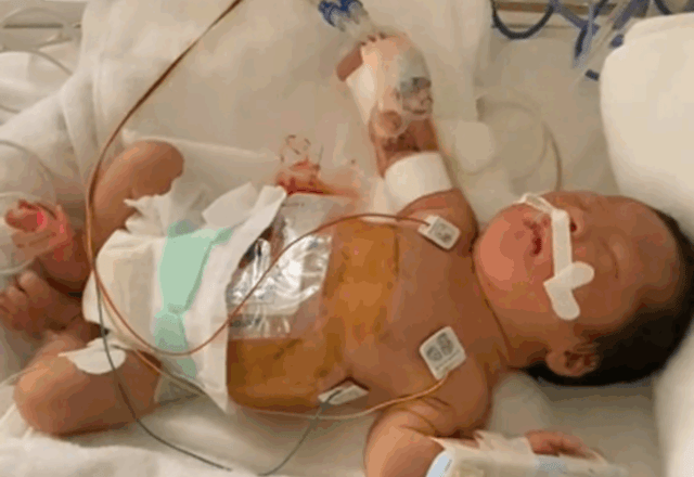 生まれてすぐダウン症だと診断された双子。「お尻の穴がなく、白血球も異常で…」1歳になった現在の様子に迫る