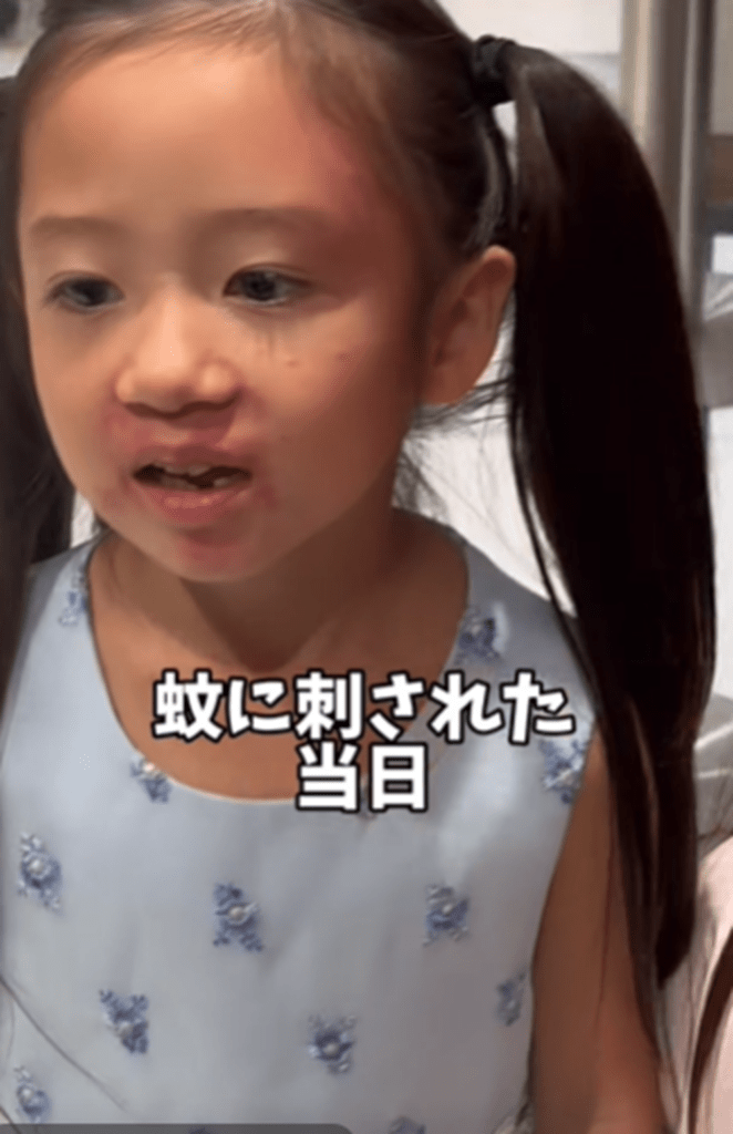 蚊に刺された当日（＠the_mk_familyさんより提供）