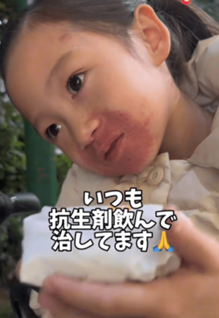 抗生剤を飲んで治しています（＠the_mk_familyさんより提供）