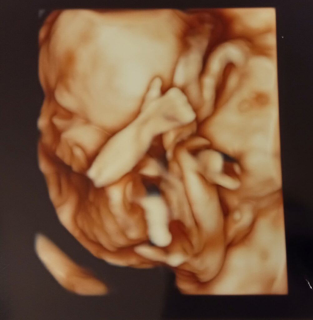 【実際の写真】撮影されたエコー写真