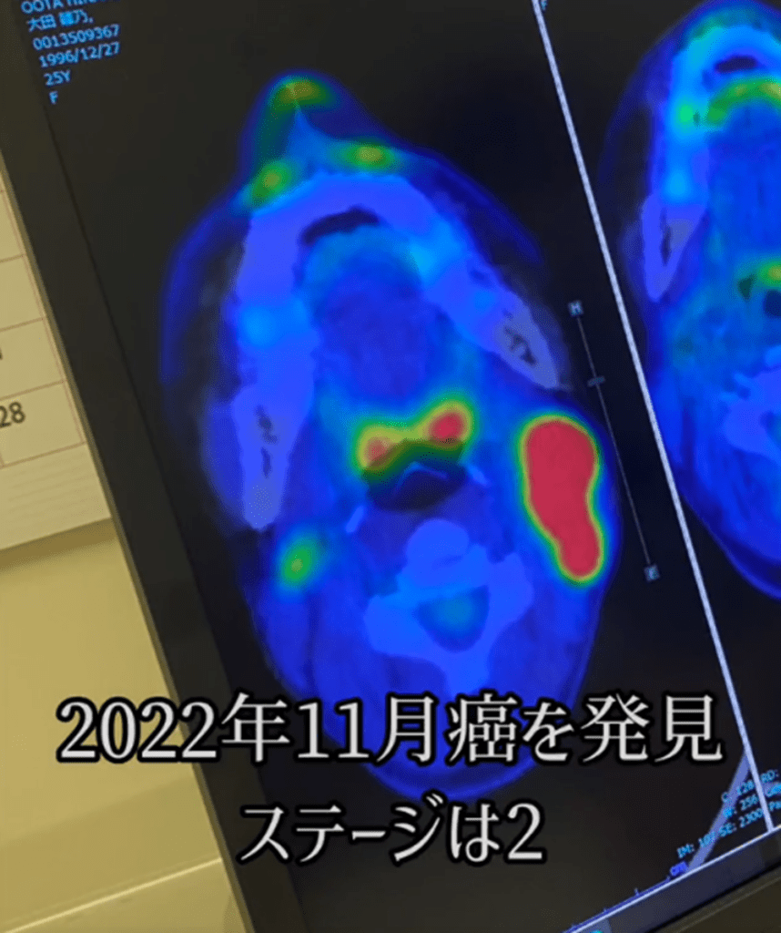 28歳でがんに…（@onepunchman19961227さんより提供）