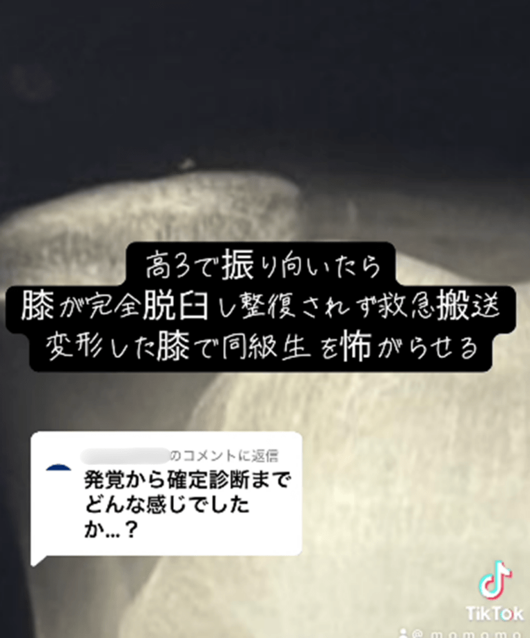 振り向いたときに完全脱臼（＠_m_o_m_o_m_o_さんより提供）