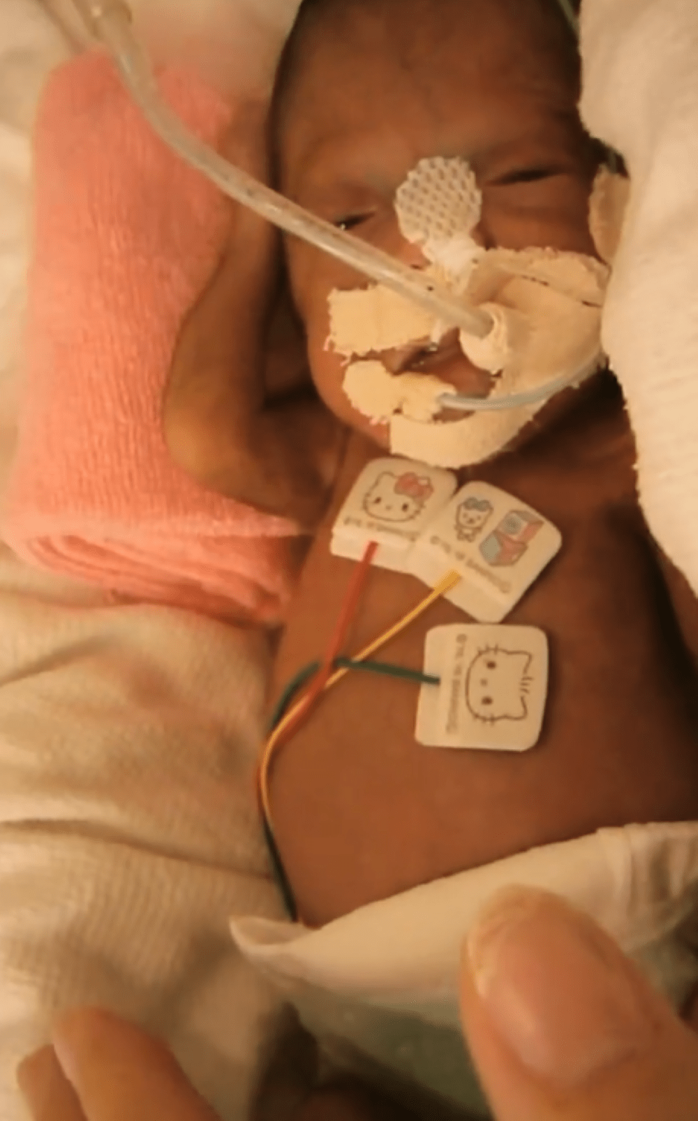 妊娠20週目で大量出血し…557gで生まれた赤ちゃん。それから3年、現在の姿に「これからの成長が楽しみですね」の声