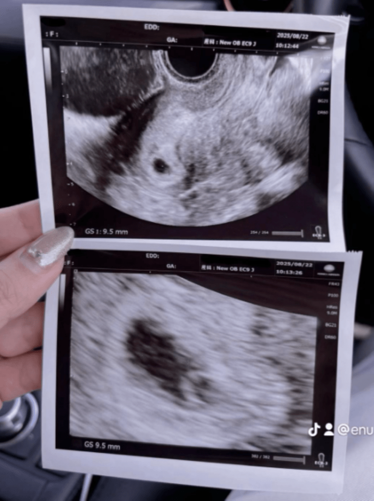 【実際の写真】ママが驚いたエコー写真