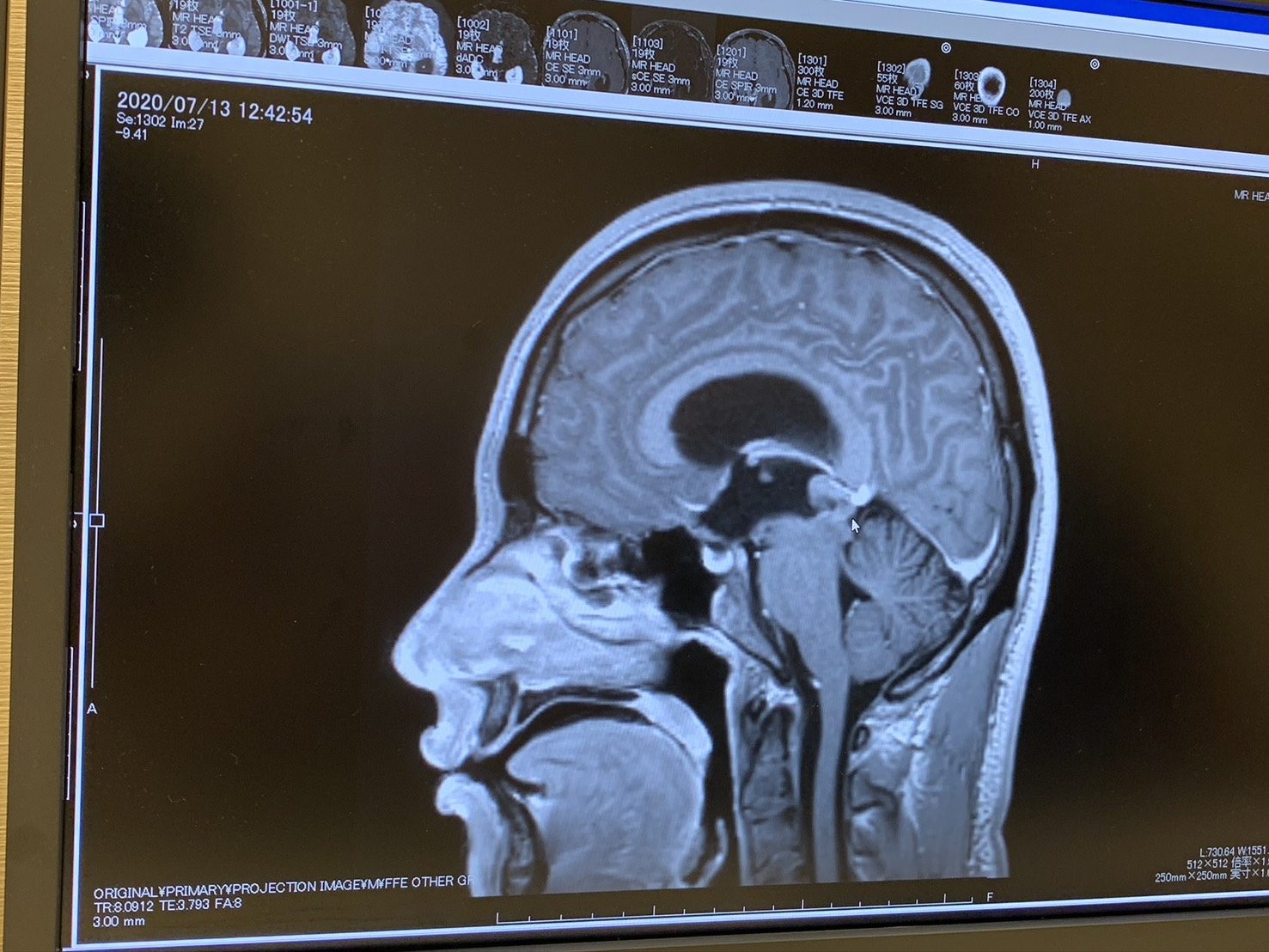 起床時の頭痛と吐き気に違和感を覚えた男性。病院に行くと医師「緊急入院です」告げられた病とは