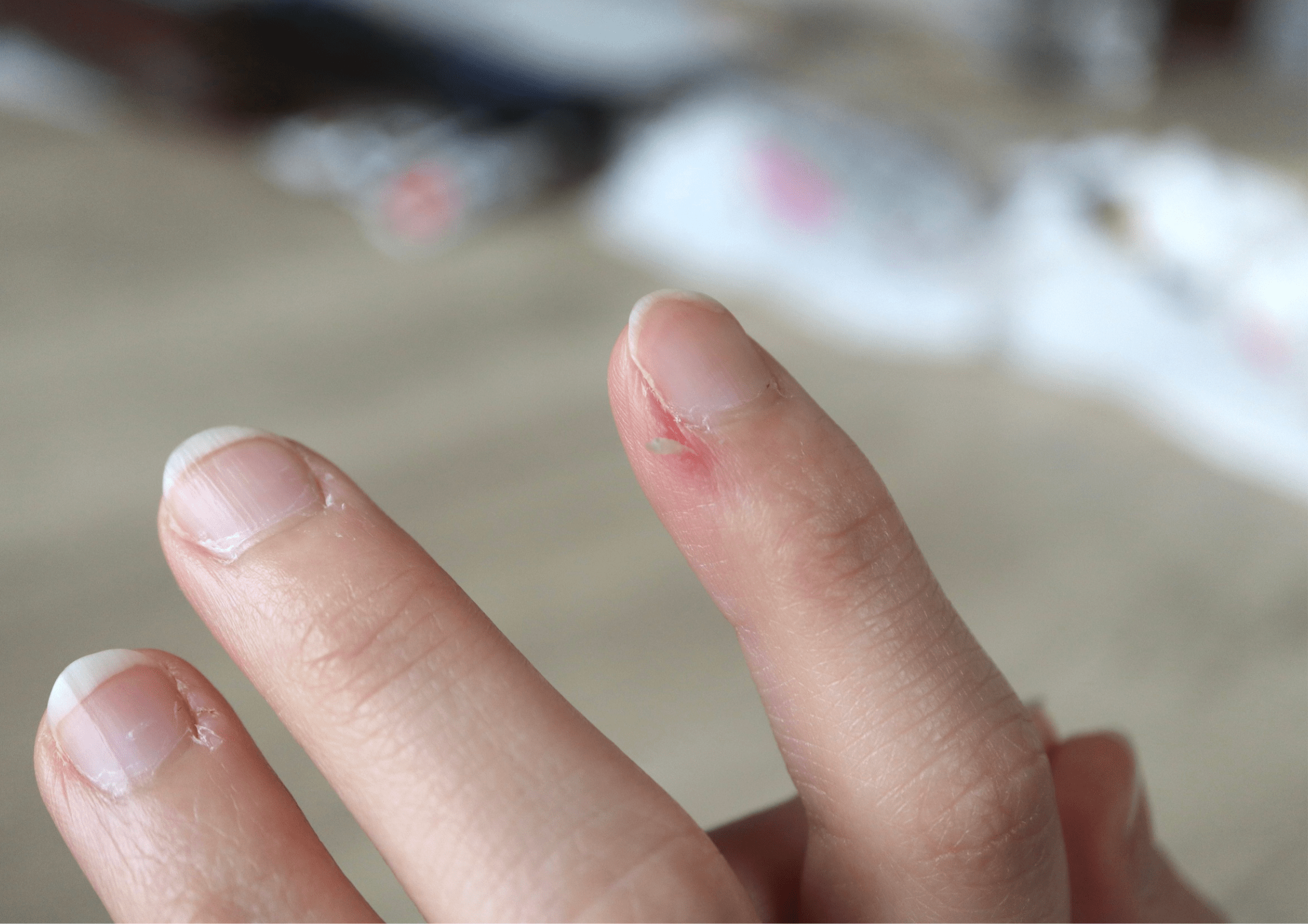 指に違和感を覚えた女性「ささくれだと思っていたら…」→まさかの状態に…「ゾッとした」「本当に驚きました」「想像していなかった」