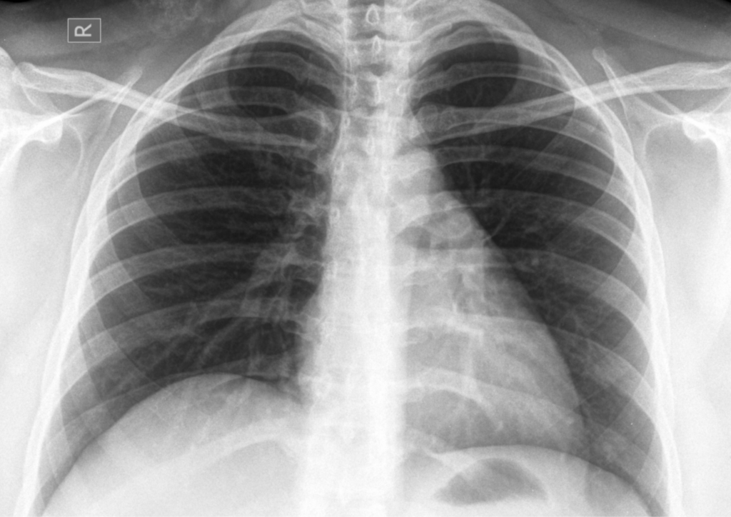 肺炎の診断結果