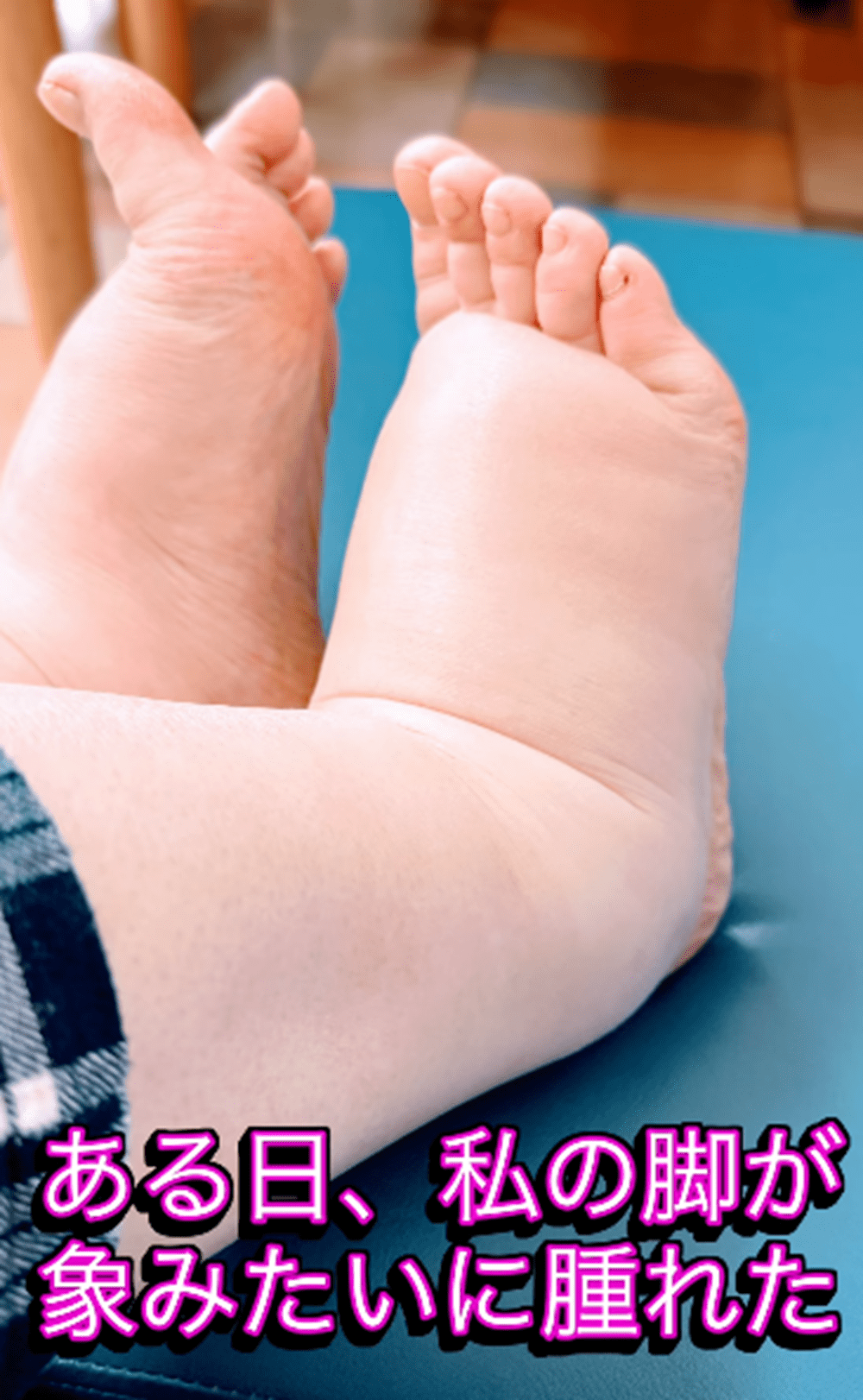 ある日突然、象のようにむくんだ足に違和感。午後には歩くのも難しくなり…医師「命の危険があります」判明した病とは