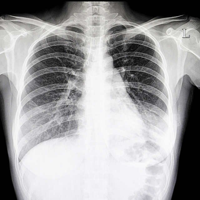 マイコプラズマ肺炎