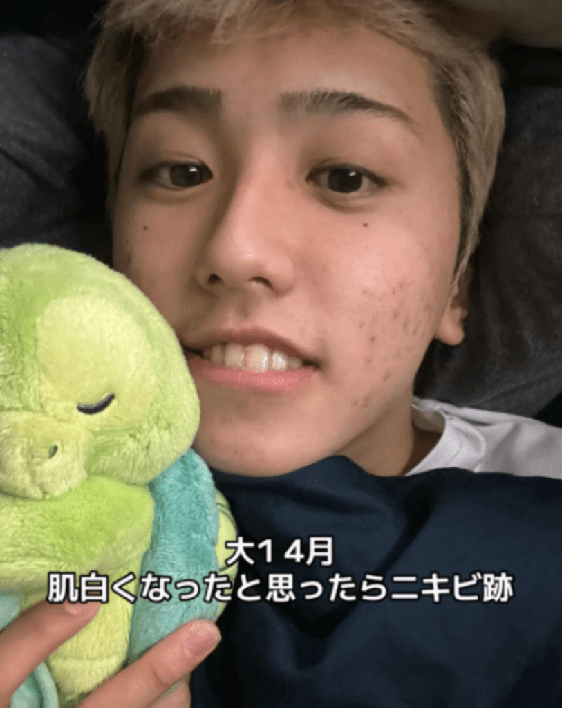 当時の悩み・ニキビ跡（＠kumabe_takatomoさんより提供）