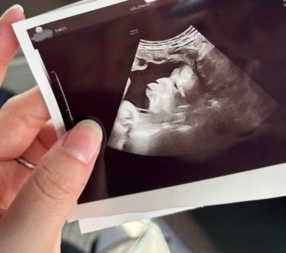 【実際の写真】エコーに写っていたもの