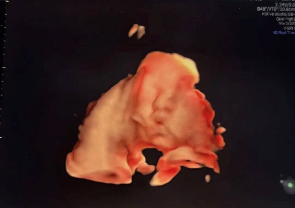 エコー写真（＠yun.nameさんより提供）