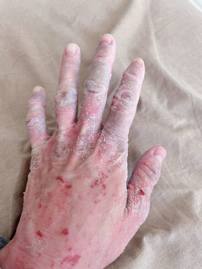 手荒れがひどかった昔①（@chanc_227さんより提供）