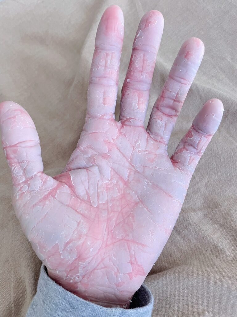 手荒れがひどかった昔②（@chanc_227さんより提供）