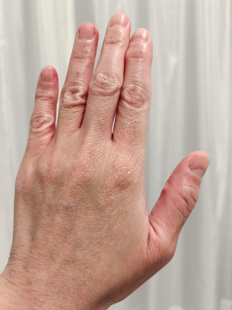 現在の手①（@chanc_227さんより提供）