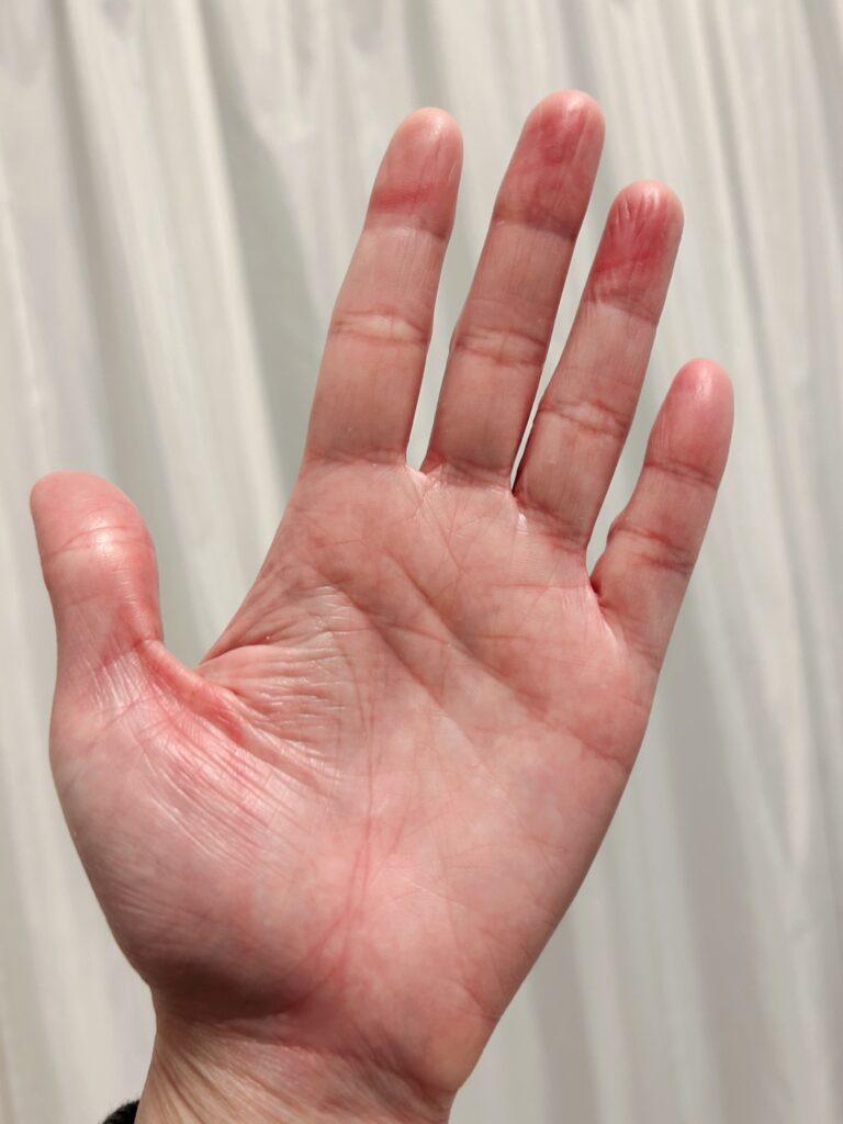 現在の手②（@chanc_227さんより提供）