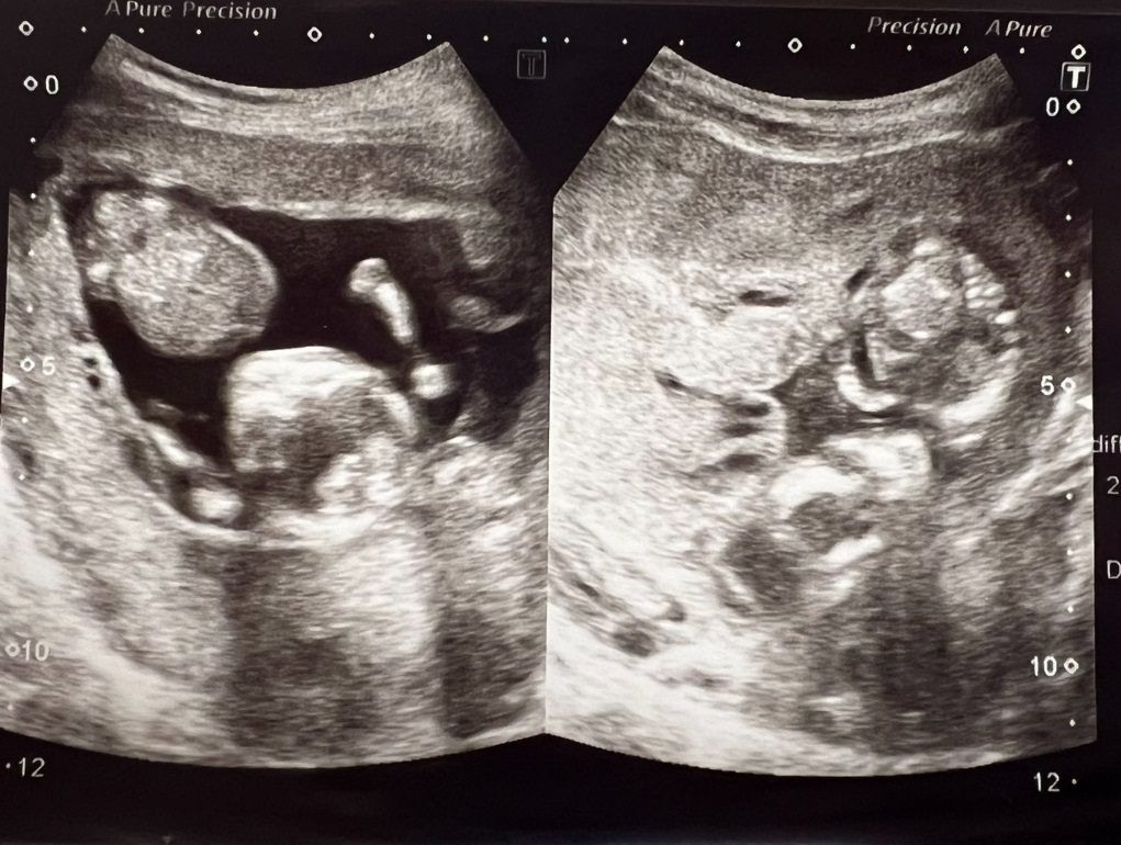 羊水がほぼない状態と診断された日のエコー写真 （@keroppi__keroppiさんより提供）