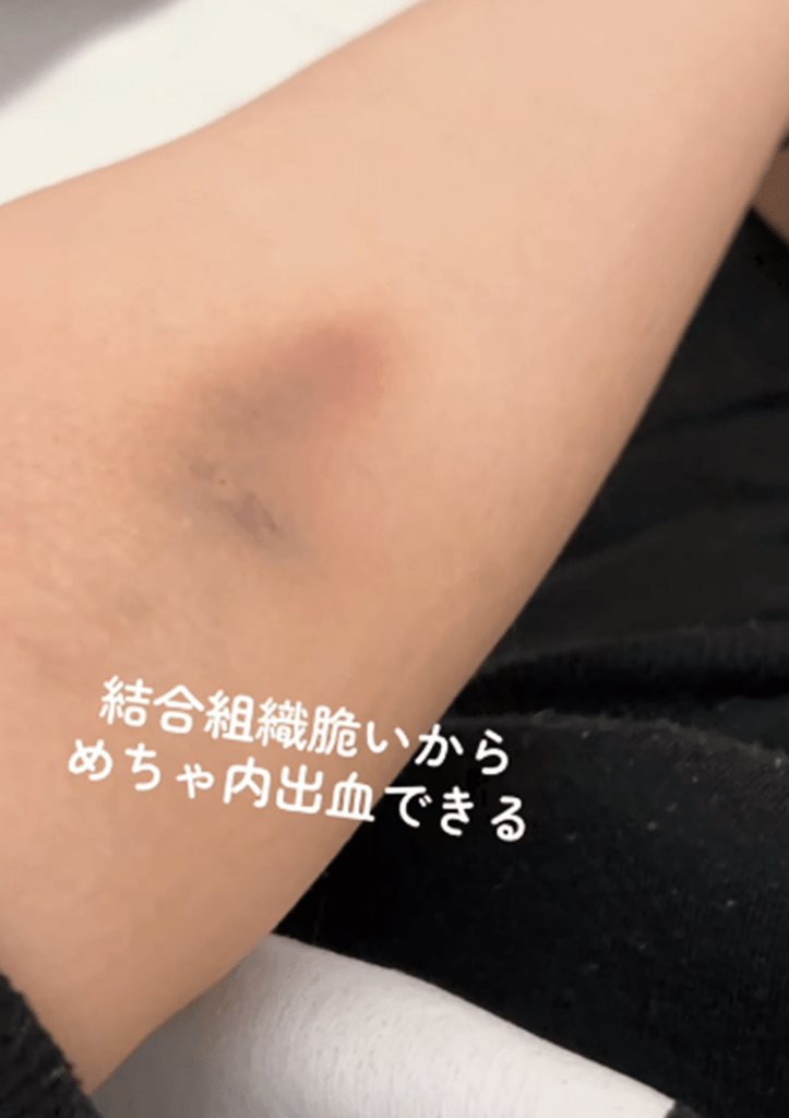 エーラスダンロス症候群の症状②（@301pon.edsさんより提供）