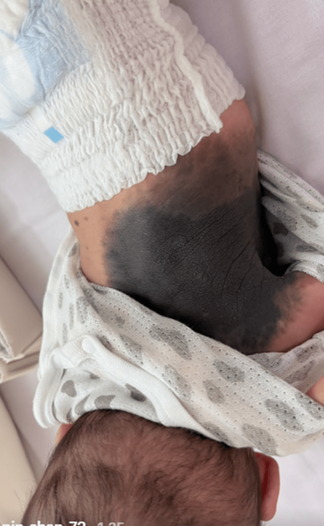 「巨大色素性母斑」と診断③（@pin_chan_72さんより提供）