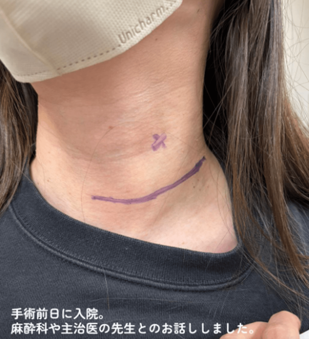 女性「なんの自覚症状もなかった」健康診断で検査した結果…→医者「腫瘍があります」手術になった女性の体験に「大変」の声