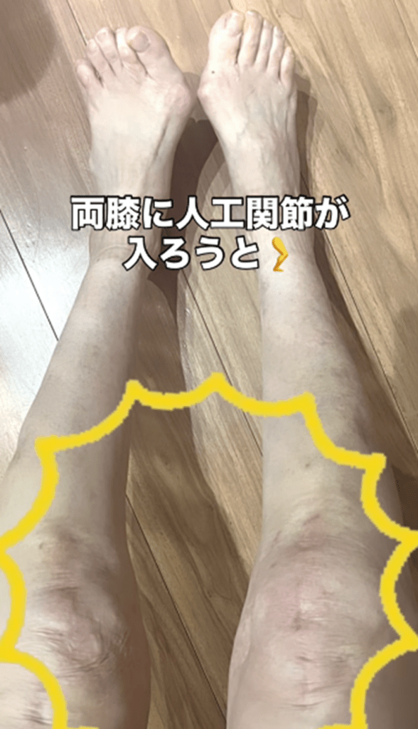 人工関節を入れても（ミカそらヒカルさんより提供）